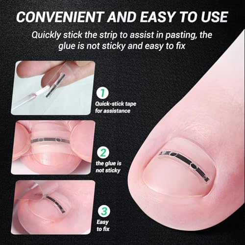 Titanium Alloy Ingrown Toenail Treatment, Nail Tools, and Ingrown Toenail Removal Kit Specially Designed for Curved Nail Repair and Ingrown Toenail Corrector (0.59/0.67in) - size: 0.59/0.67in