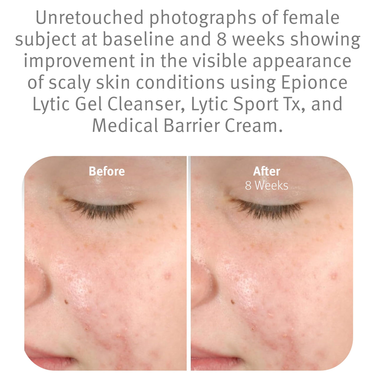 Epionce Lytic Gel Cleanser Gentle Foaming Face Wash Blemish Makeup Remover