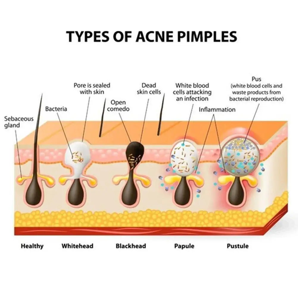 Blackhead Remover Nose Patches